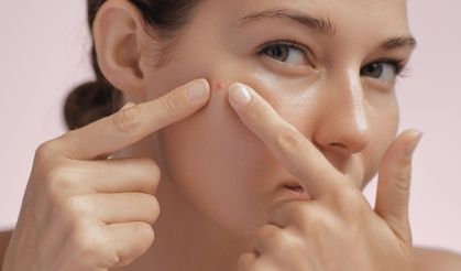 Yaz Sonrası Sivilcelenme Nedenleri