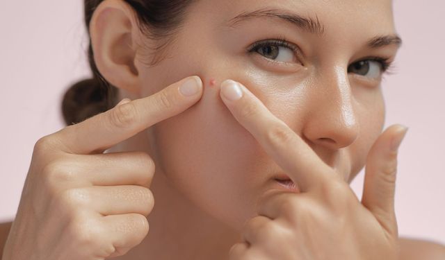 Yaz Sonrası Sivilcelenme Nedenleri