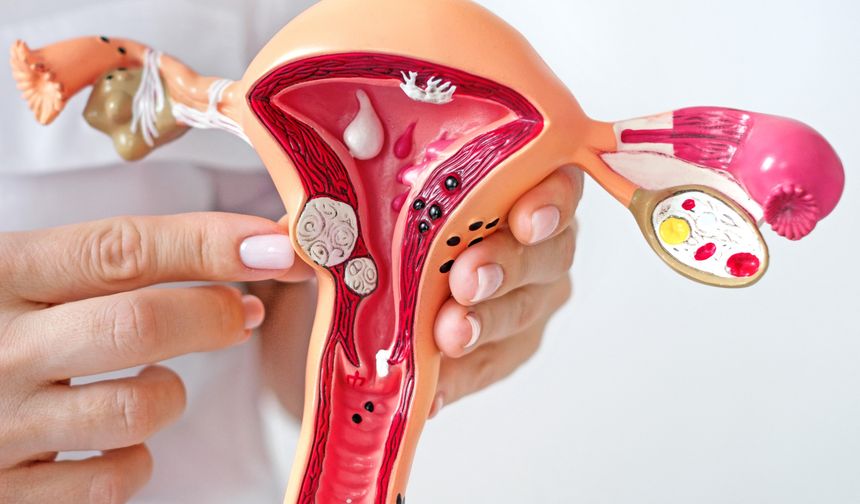 Birçok Kadında Var Ancak Fark Edilmiyor: Miyom Gerçeği!