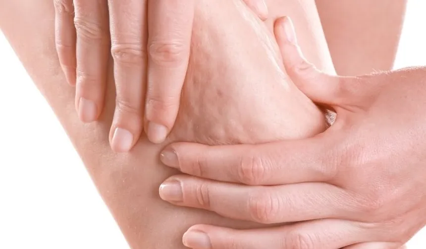 Uzman uyarısı: Portakal kabuğu görüntüsü basit sorun değil!